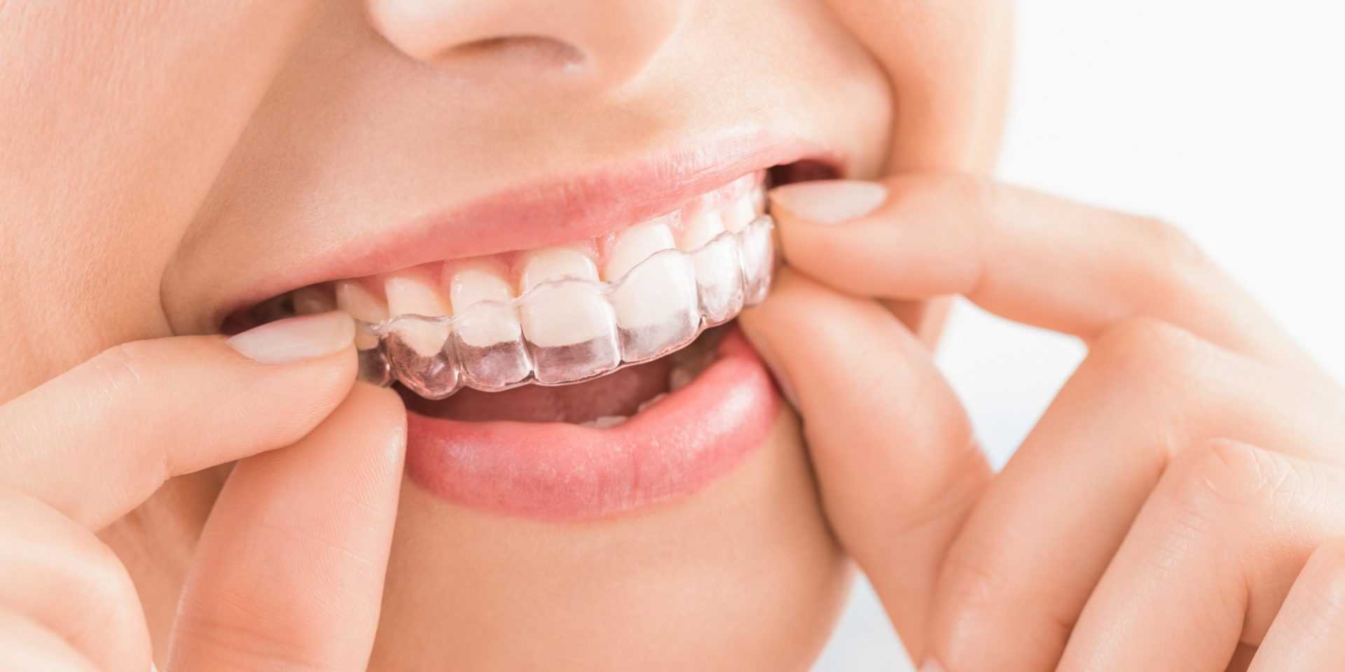 Dentiste invisalign Casablanca anfa , dentiste orthodontiste anfa Casablanca